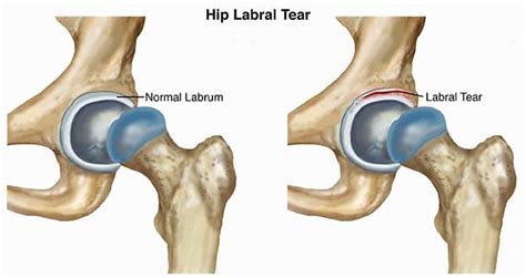 acetabular labrum hip surgery